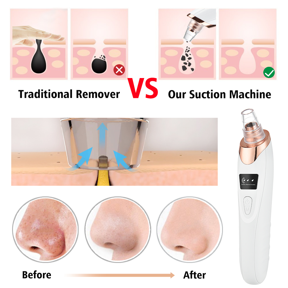 Penghilang Komedo Pembersih Po - Nasal Aspirator ulasan dan harga